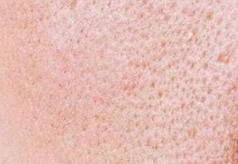 臉部毛孔粗大如何改善 幾個(gè)小妙招教給你