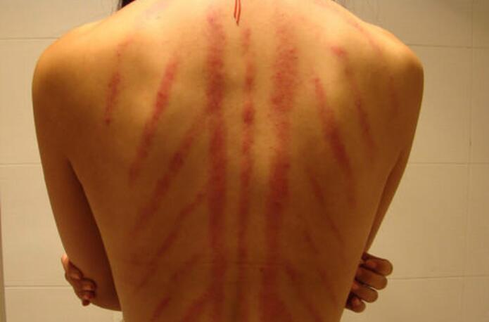 美容培訓(xùn)：哪些人不是做背部刮痧