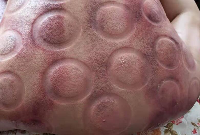 怎樣拔火罐？南寧美容學(xué)校手把手教你