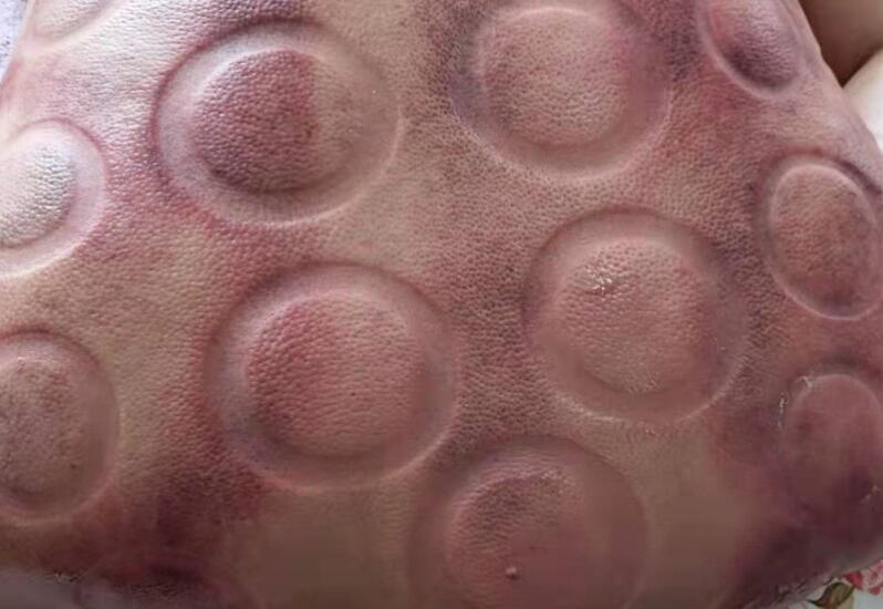 拔火罐有什么用？廣西美容職業(yè)培訓(xùn)學(xué)校演示給你看