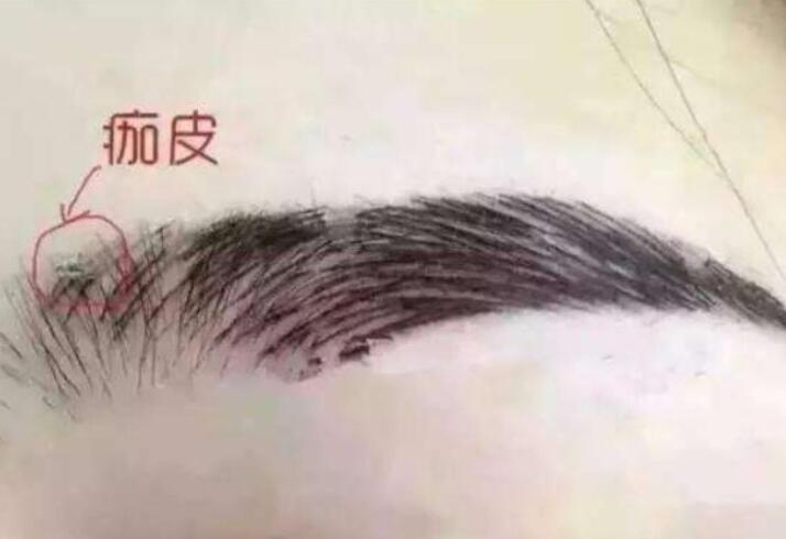 紋眉結(jié)痂時要注意什么？麗紋竹繡學(xué)校教你