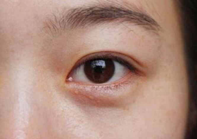 黑眼圈的種類有哪些？廣西美容培訓(xùn)教你保養(yǎng)