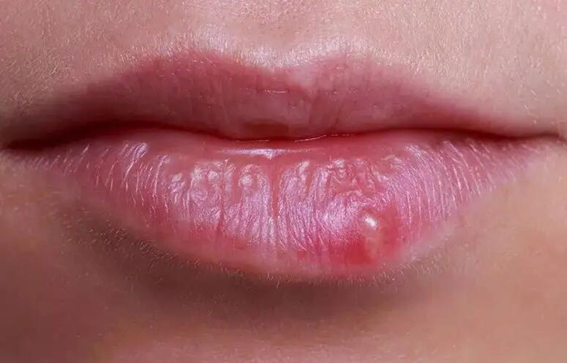 紋唇后起泡怎么辦？南寧紋唇培訓(xùn)學(xué)校教你方法