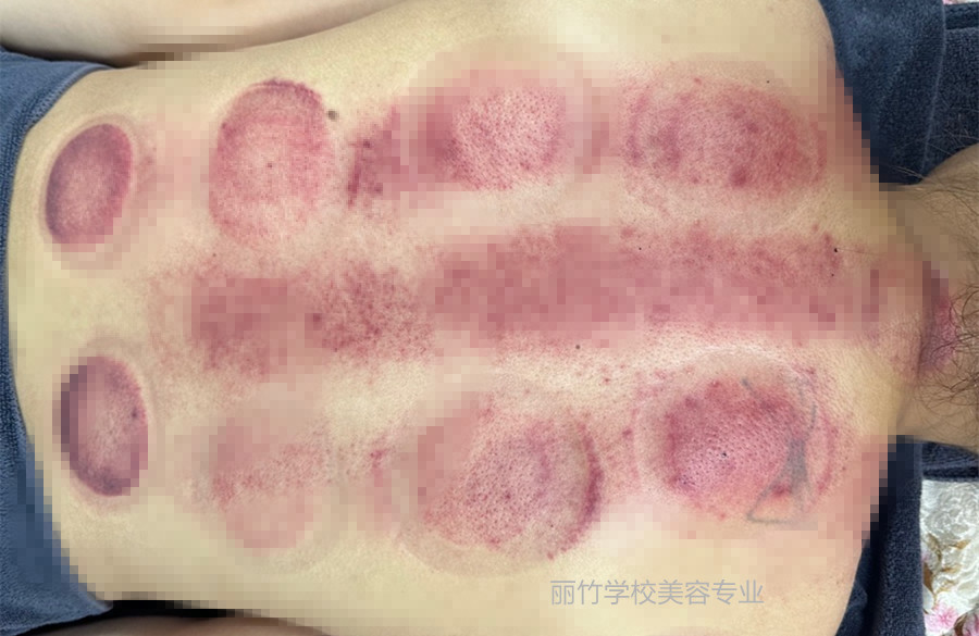 拔火罐的顏色代表什么？南寧美容美體專業(yè)實訓(xùn)