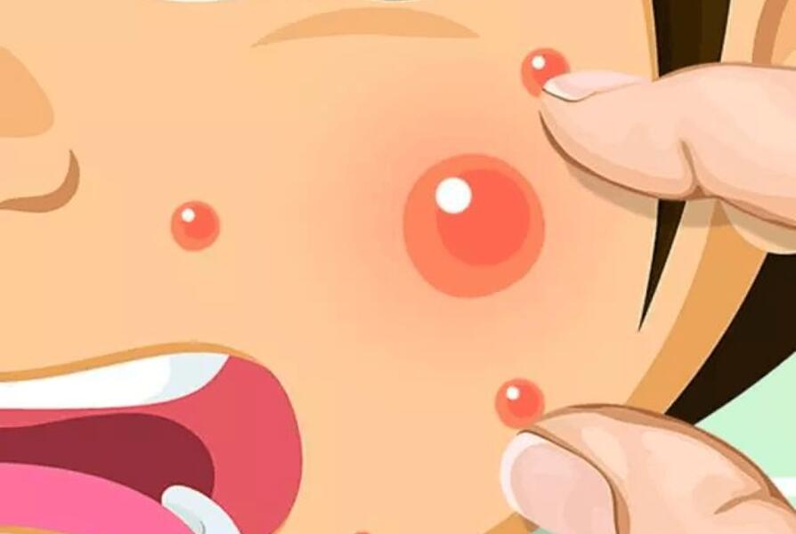 南寧皮膚管理專(zhuān)業(yè)：正確處理閉口的管理方法