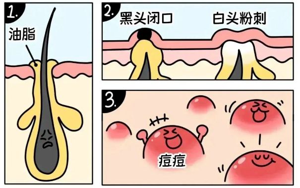 不同部位閉口形成的原因，南寧美容護膚學校解答